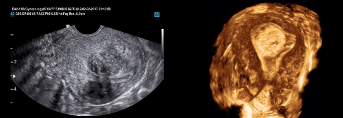 Ecografia transvaginale